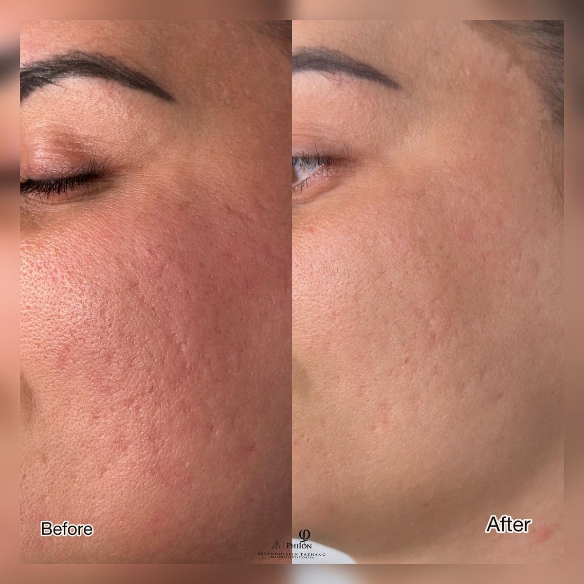 Acne Scar Surgery