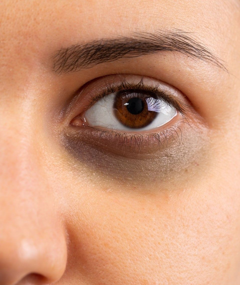 Dark Circles Skincare Treatment