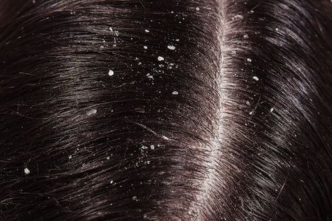Dandruff Treatment