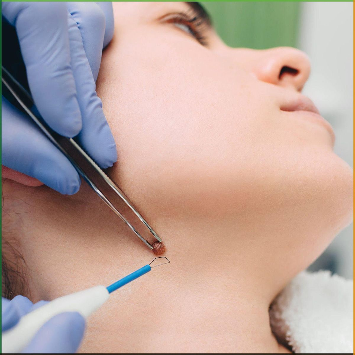 Skin Tag Removal