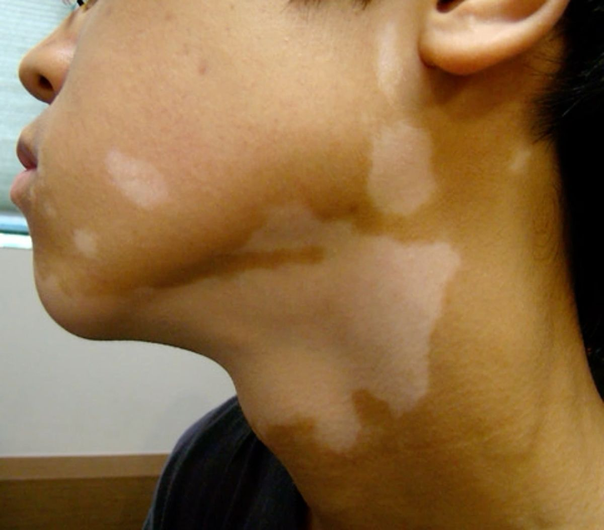 Vitiligo Surgery